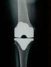 protesi al ginocchio radiografia